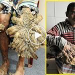 Ağaç adam hastalığı: Epidermodysplasia Verruciformis