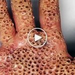 Tripofobi-nedir-Tripofobi-nasıl-geçer-Tripofobi-nasıl-olur-izle