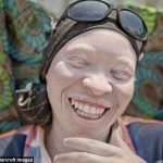 Tanzanya’nın büyücülerden kaçan lanetli halkı: Albinolar