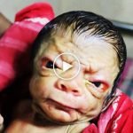 Yaşlı doğan bebek: Progeri (Progeria)